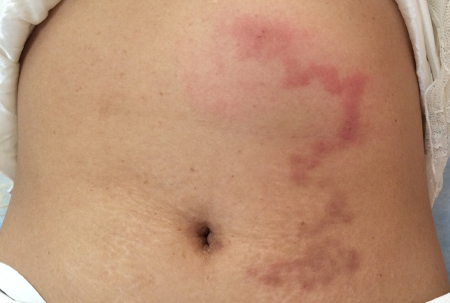 Punture insetti addome